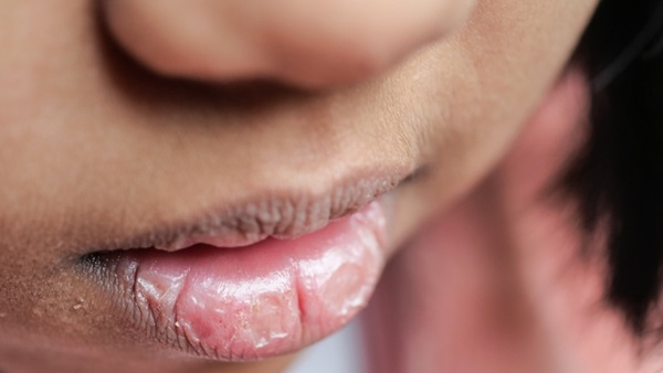 Enfant aux lèvres gercées et abimées